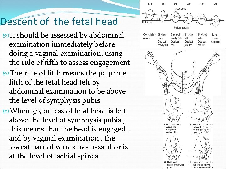 Descent of the fetal head It should be assessed by abdominal examination immediately before