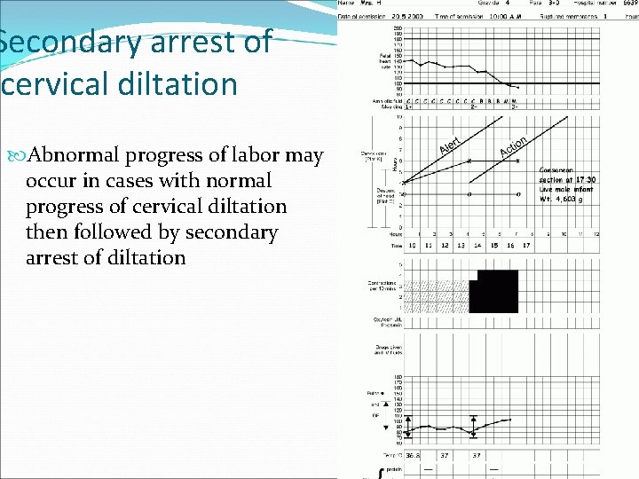 Secondary arrest of cervical diltation Abnormal progress of labor may occur in cases with