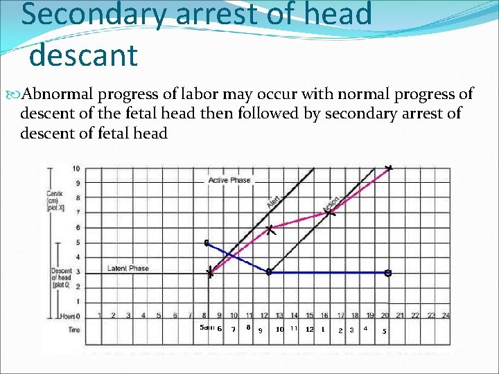 Secondary arrest of head descant Abnormal progress of labor may occur with normal progress