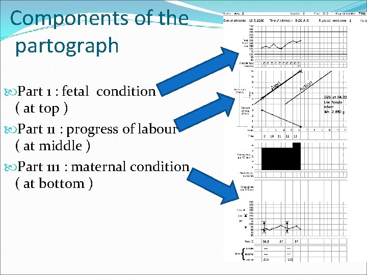 Components of the partograph Part 1 : fetal condition ( at top ) Part