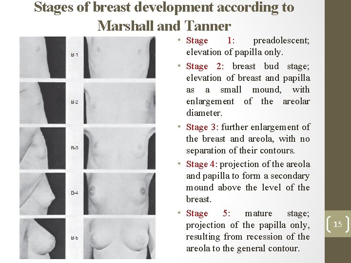 Stages of breast development according to Marshall and Tanner • Stage 1: preadolescent; elevation