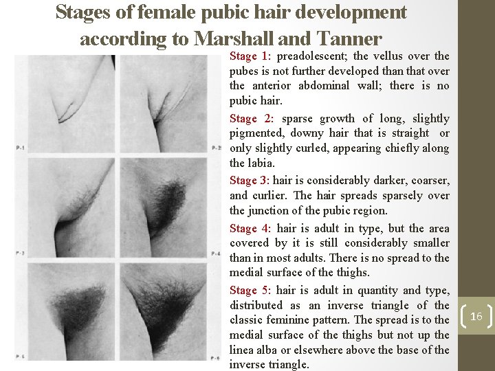 Stages of female pubic hair development according to Marshall and Tanner • Stage 1: