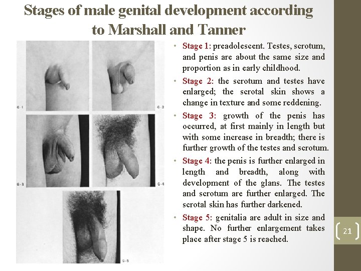 Stages of male genital development according to Marshall and Tanner • Stage 1: preadolescent.