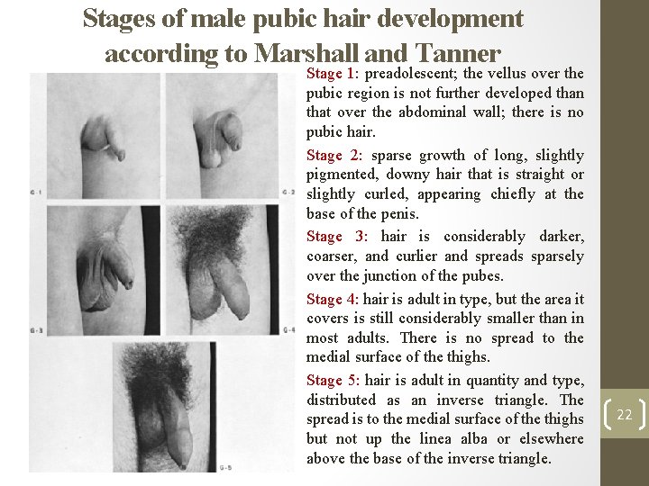 Stages of male pubic hair development according to Marshall and Tanner • Stage 1: