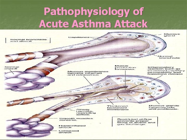 Pathophysiology of Acute Asthma Attack 