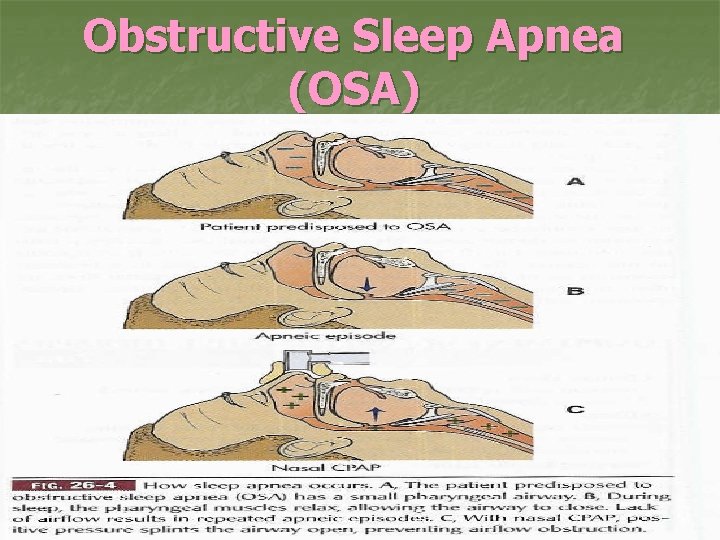 Obstructive Sleep Apnea (OSA) 