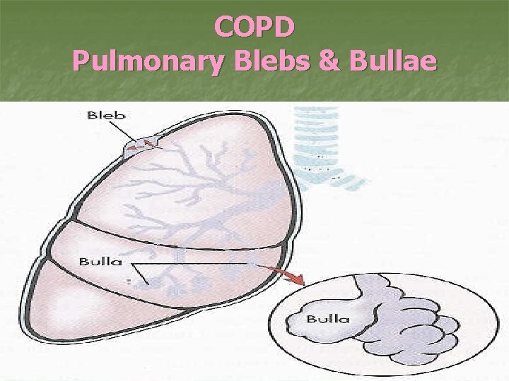 COPD Pulmonary Blebs & Bullae 