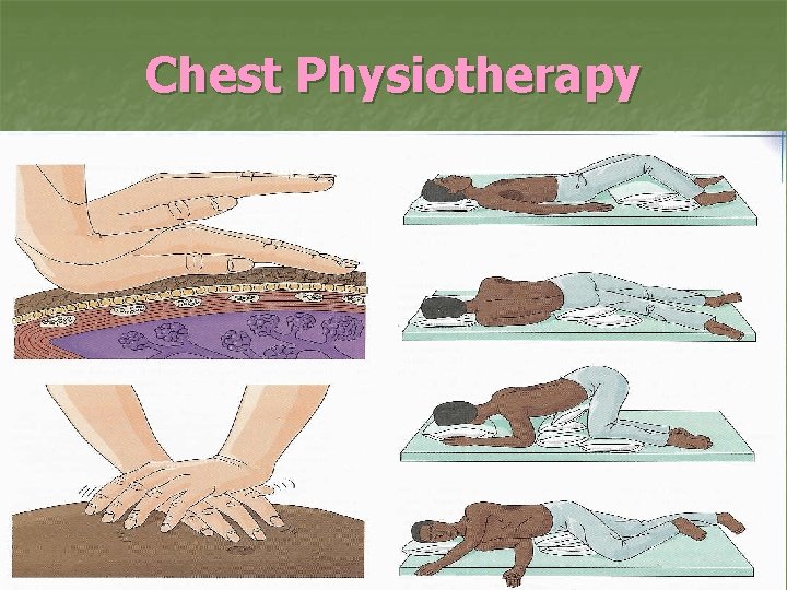 Chest Physiotherapy 
