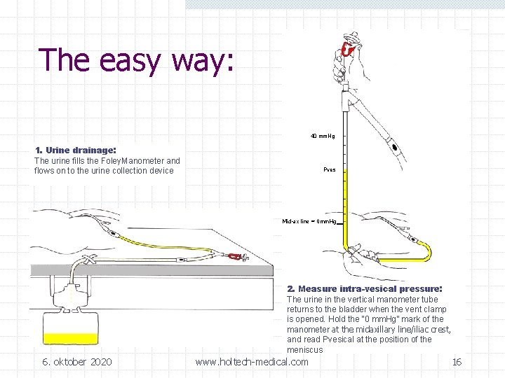 The easy way: 40 mm. Hg 1. Urine drainage: The urine fills the Foley.