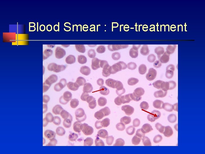 Blood Smear : Pre-treatment 