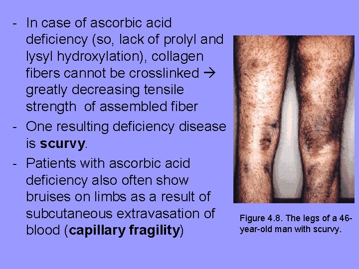 - In case of ascorbic acid deficiency (so, lack of prolyl and lysyl hydroxylation), - In case of ascorbic acid deficiency (so, lack of prolyl and lysyl hydroxylation),