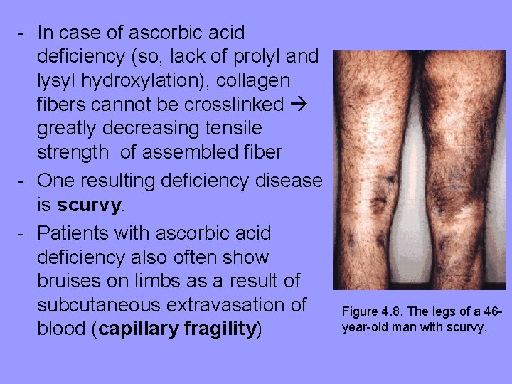 - In case of ascorbic acid deficiency (so, lack of prolyl and lysyl hydroxylation),