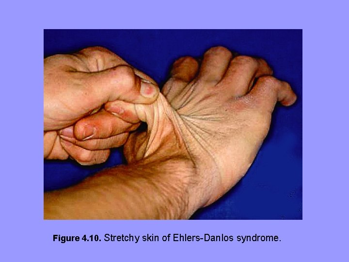 Figure 4. 10. Stretchy skin of Ehlers-Danlos syndrome. Figure 4. 10. Stretchy skin of Ehlers-Danlos syndrome.