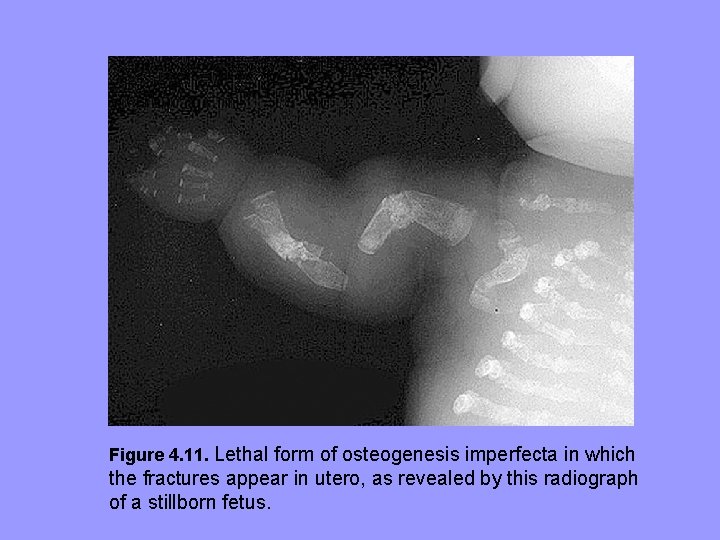 Figure 4. 11. Lethal form of osteogenesis imperfecta in which the fractures appear in