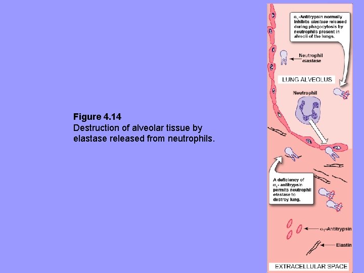 Figure 4. 14 Destruction of alveolar tissue by elastase released from neutrophils. Figure 4. 14 Destruction of alveolar tissue by elastase released from neutrophils.