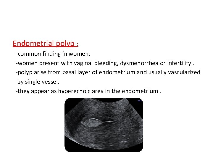 Endometrial polyp : -common finding in women. -women present with vaginal bleeding, dysmenorrhea or