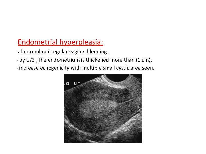 Endometrial hyperpleasia: -abnormal or irregular vaginal bleeding. - by U/S , the endometrium is