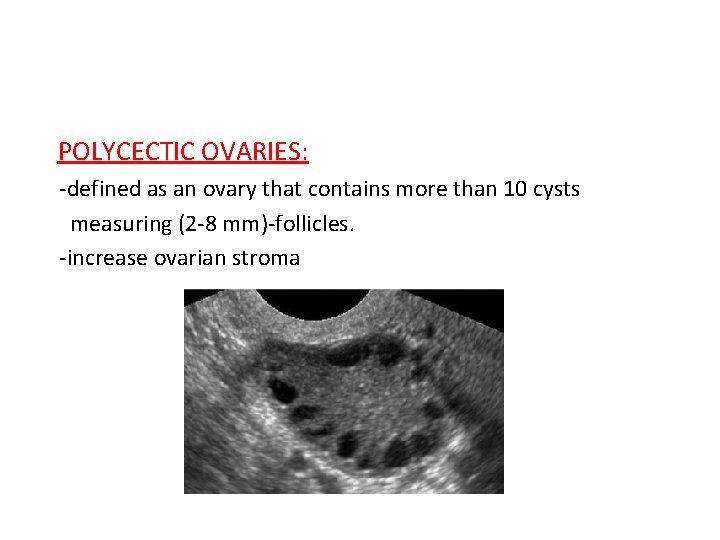 POLYCECTIC OVARIES: -defined as an ovary that contains more than 10 cysts measuring (2