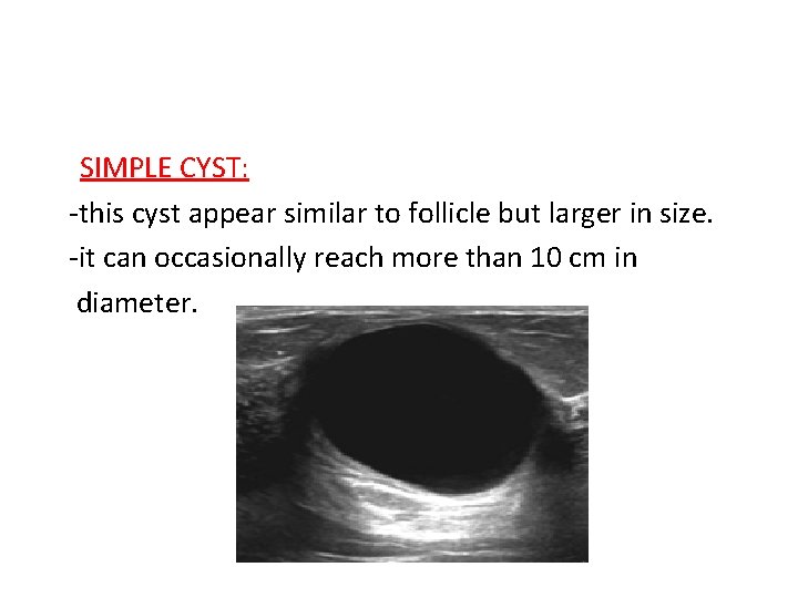 SIMPLE CYST: -this cyst appear similar to follicle but larger in size. -it can
