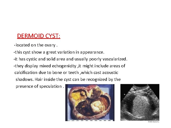 DERMOID CYST: -located on the ovary. -this cyst show a great variation in appearance.