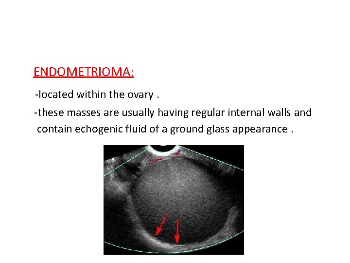 ENDOMETRIOMA: -located within the ovary. -these masses are usually having regular internal walls and