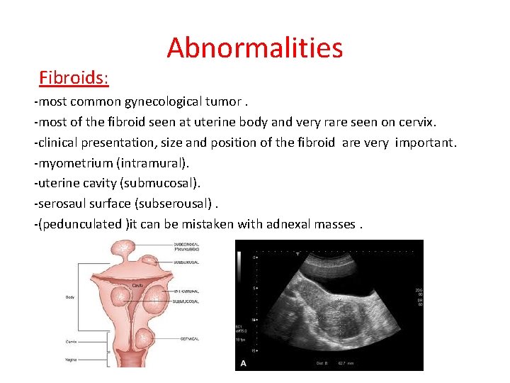 Fibroids: Abnormalities -most common gynecological tumor. -most of the fibroid seen at uterine body