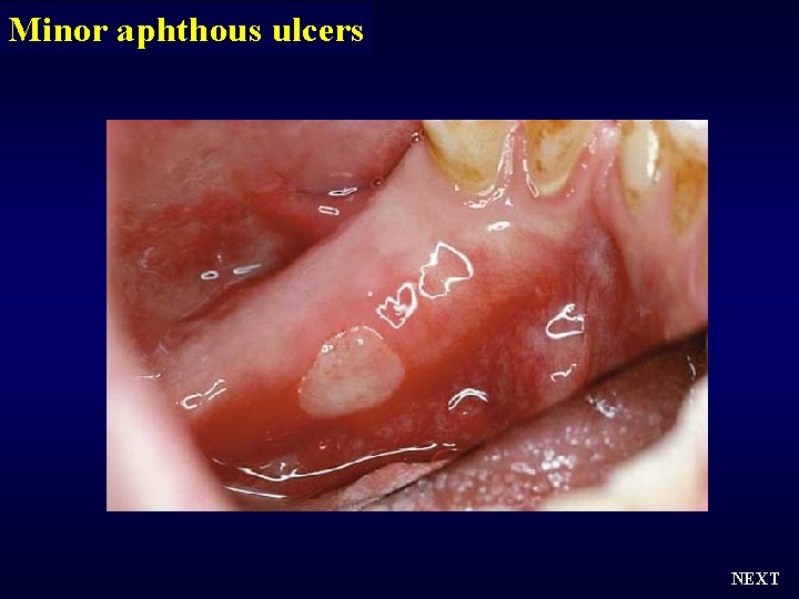 Minor aphthous ulcers NEXT 