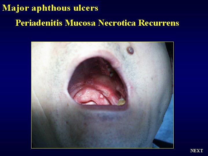 Major aphthous ulcers Periadenitis Mucosa Necrotica Recurrens NEXT 
