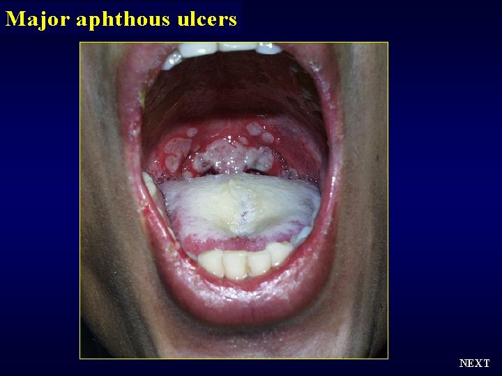 Major aphthous ulcers NEXT 