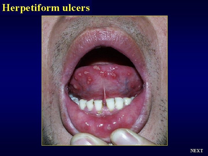 Herpetiform ulcers NEXT 