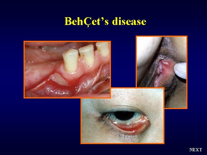 BehÇet’s disease NEXT 