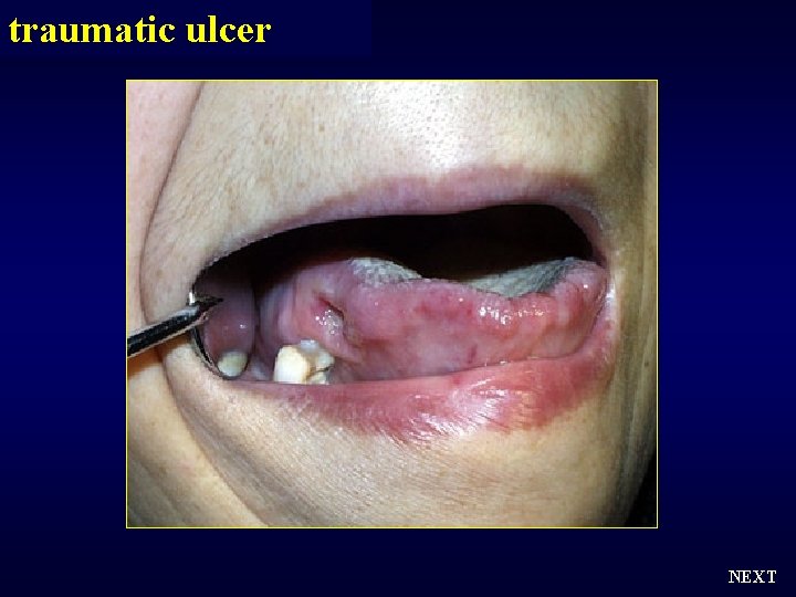 traumatic ulcer NEXT 