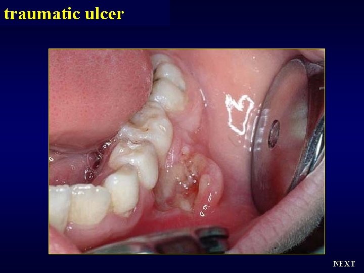 traumatic ulcer NEXT 