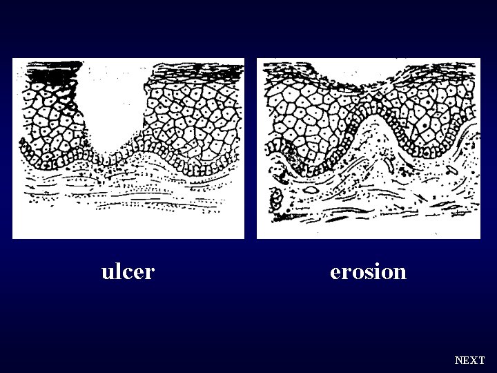 ulcer erosion NEXT 