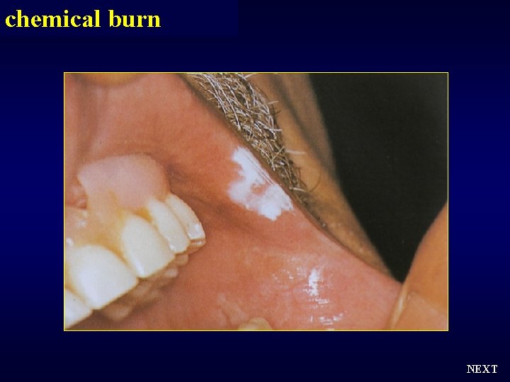 chemical burn NEXT 