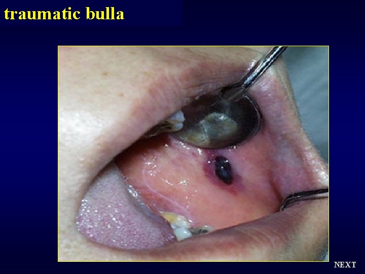 traumatic bulla NEXT 