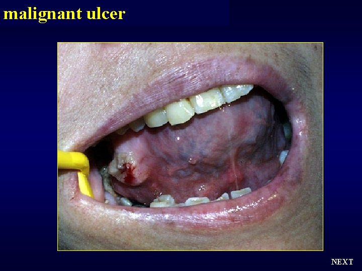 malignant ulcer NEXT 