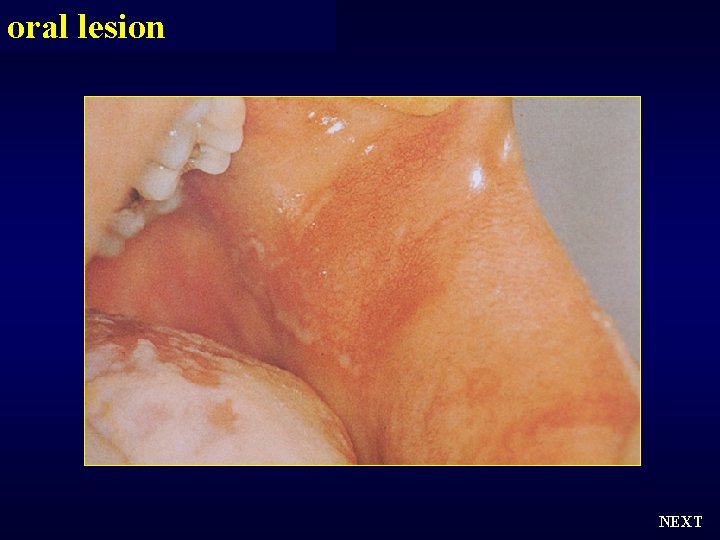 oral lesion NEXT 