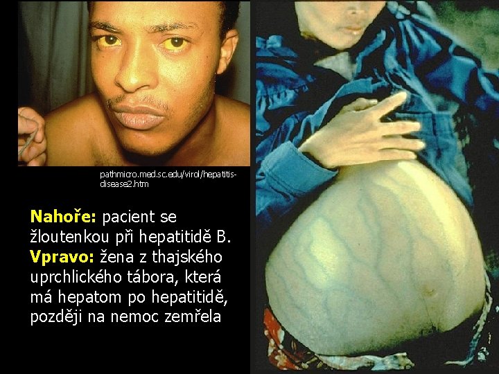 pathmicro. med. sc. edu/virol/hepatitisdisease 2. htm Nahoře: pacient se žloutenkou při hepatitidě B. Vpravo: