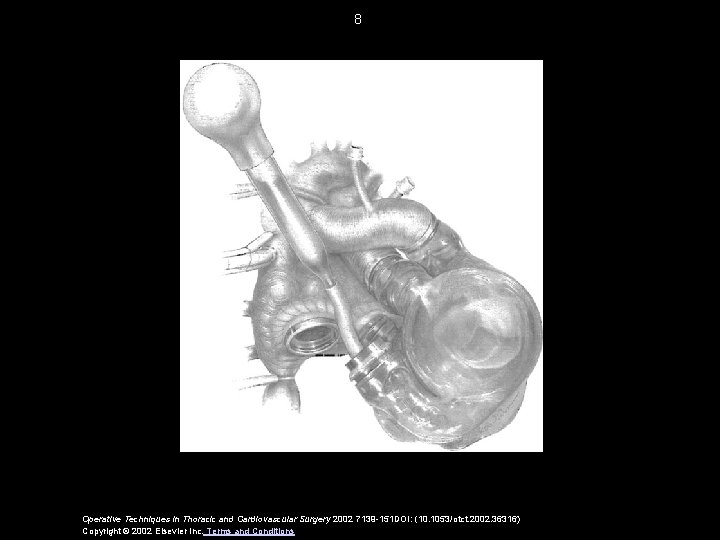 8 Operative Techniques in Thoracic and Cardiovascular Surgery 2002 7139 -151 DOI: (10. 1053/otct.