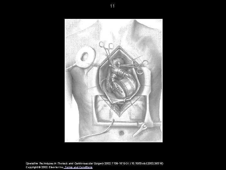 11 Operative Techniques in Thoracic and Cardiovascular Surgery 2002 7139 -151 DOI: (10. 1053/otct.