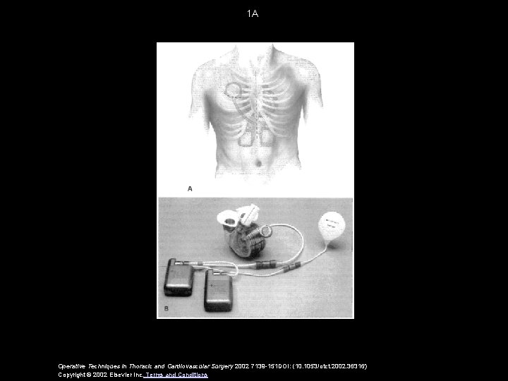 1 A Operative Techniques in Thoracic and Cardiovascular Surgery 2002 7139 -151 DOI: (10.