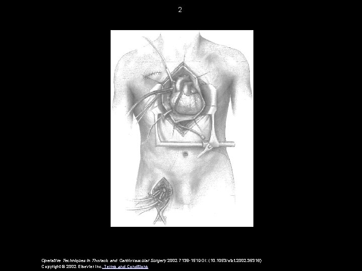 2 Operative Techniques in Thoracic and Cardiovascular Surgery 2002 7139 -151 DOI: (10. 1053/otct.