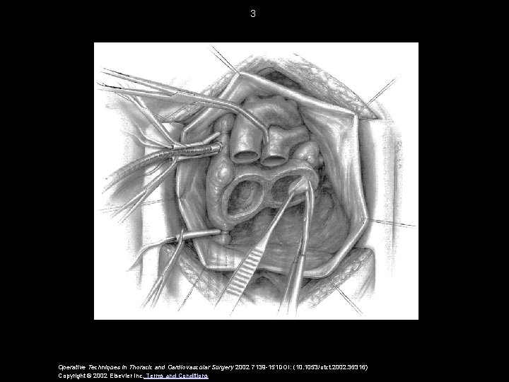 3 Operative Techniques in Thoracic and Cardiovascular Surgery 2002 7139 -151 DOI: (10. 1053/otct.