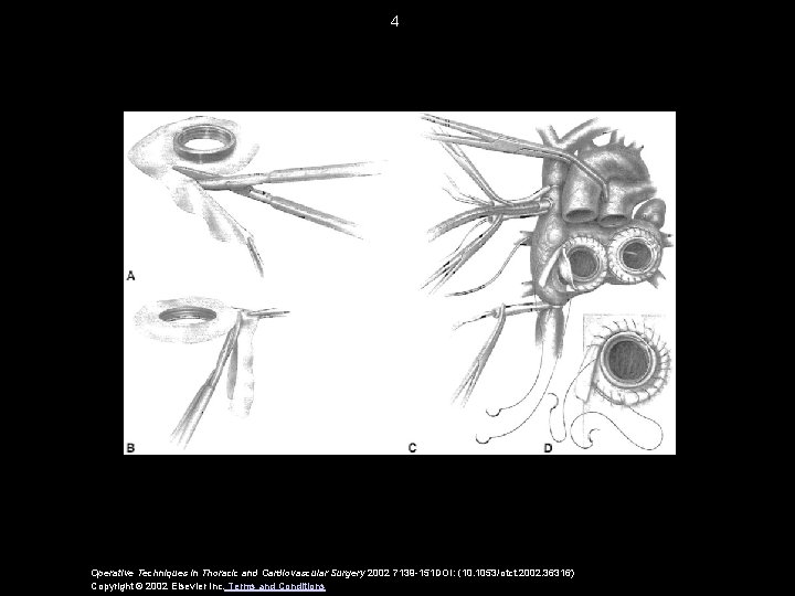 4 Operative Techniques in Thoracic and Cardiovascular Surgery 2002 7139 -151 DOI: (10. 1053/otct.