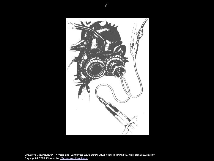 5 Operative Techniques in Thoracic and Cardiovascular Surgery 2002 7139 -151 DOI: (10. 1053/otct.