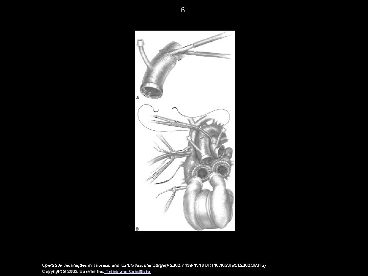 6 Operative Techniques in Thoracic and Cardiovascular Surgery 2002 7139 -151 DOI: (10. 1053/otct.