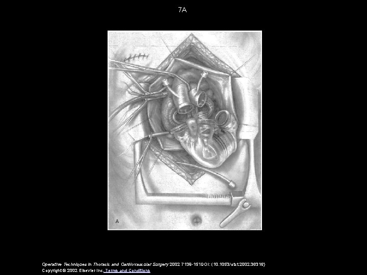 7 A Operative Techniques in Thoracic and Cardiovascular Surgery 2002 7139 -151 DOI: (10.