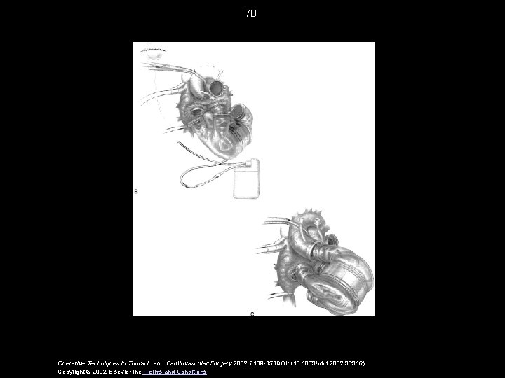 7 B Operative Techniques in Thoracic and Cardiovascular Surgery 2002 7139 -151 DOI: (10.