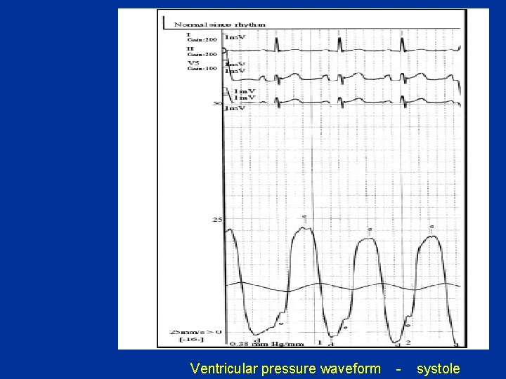 Ventricular pressure waveform - systole 